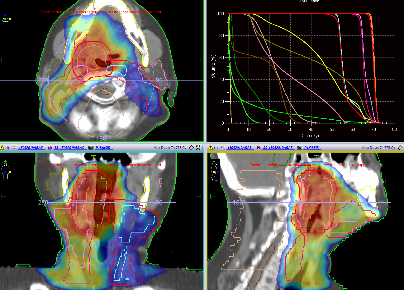 Ozařovací plán pro radioterapii nádoru ORL oblasti