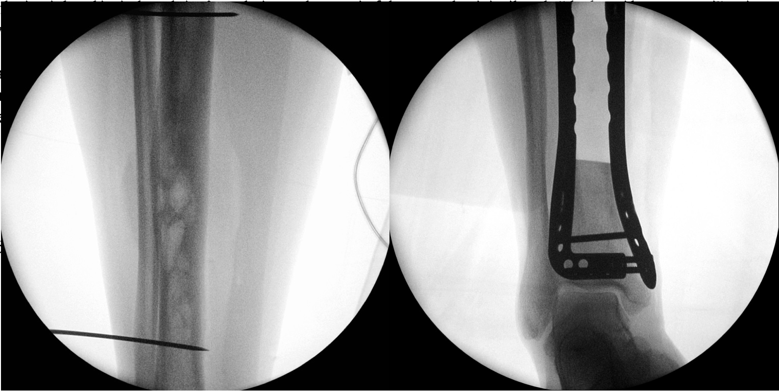 obrázky z intra-operačního rentgenového zesilovače