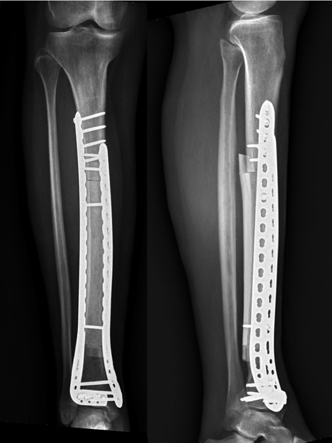 pooperační RTG: větší průměr dácovské kosti byl využit k schodovitému překrytí (“step-cut” osteotomy), které urychluje hojení a splynutí s živou kostí pacienta - tato “zlomenina” se hojí pouze z jedné strany, protože aloštěp nemá hojivý potenciál