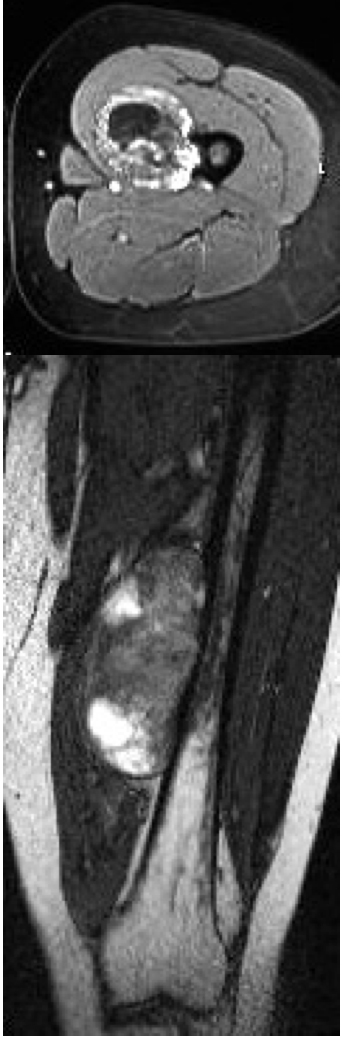 předoperační MRI ukazující tumor vyrůstající z mediální strany stehenní kosti