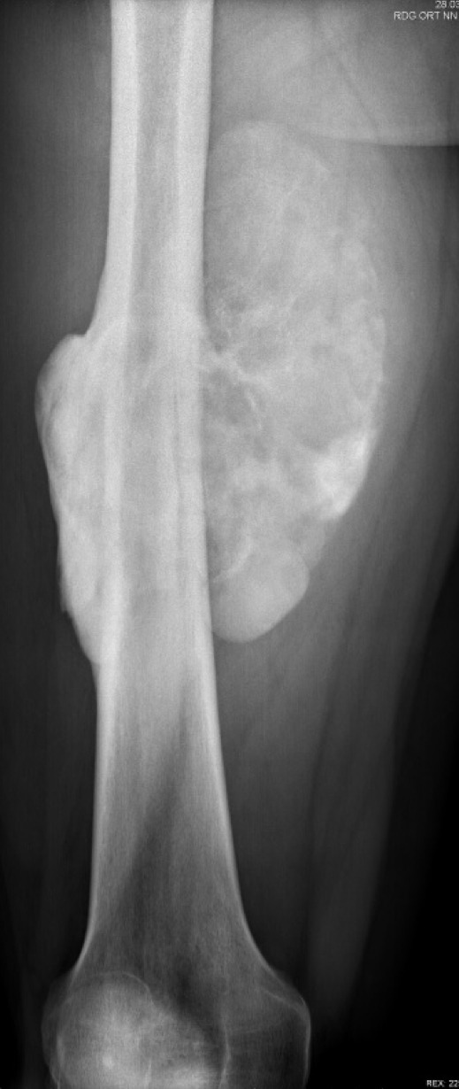 RTG ukazující objemný paraossealní osteosarkom stehenní kosti