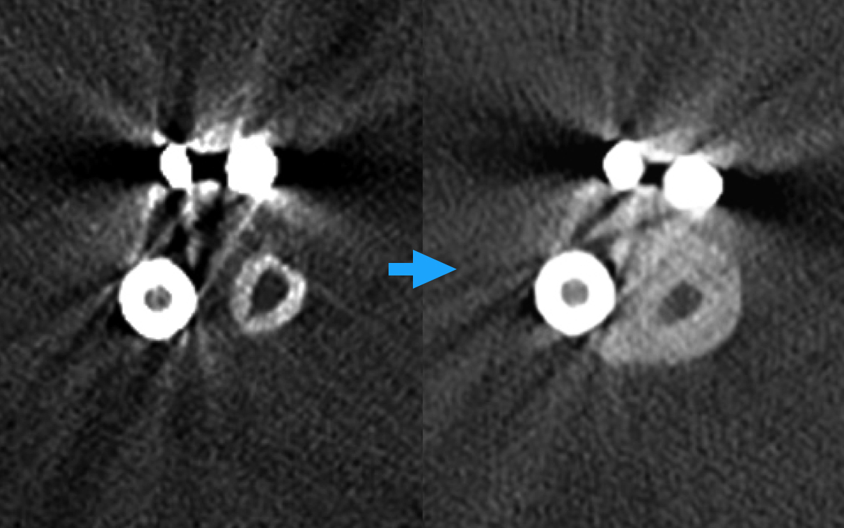 konsekutivní CT snímky, kde je vidět zesílení (hypertrofie) vaskularizovaného kostního štěpu