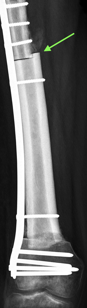 pooperační RTG - šipka ukazuje na schodovitou "step-cut" osteotomii