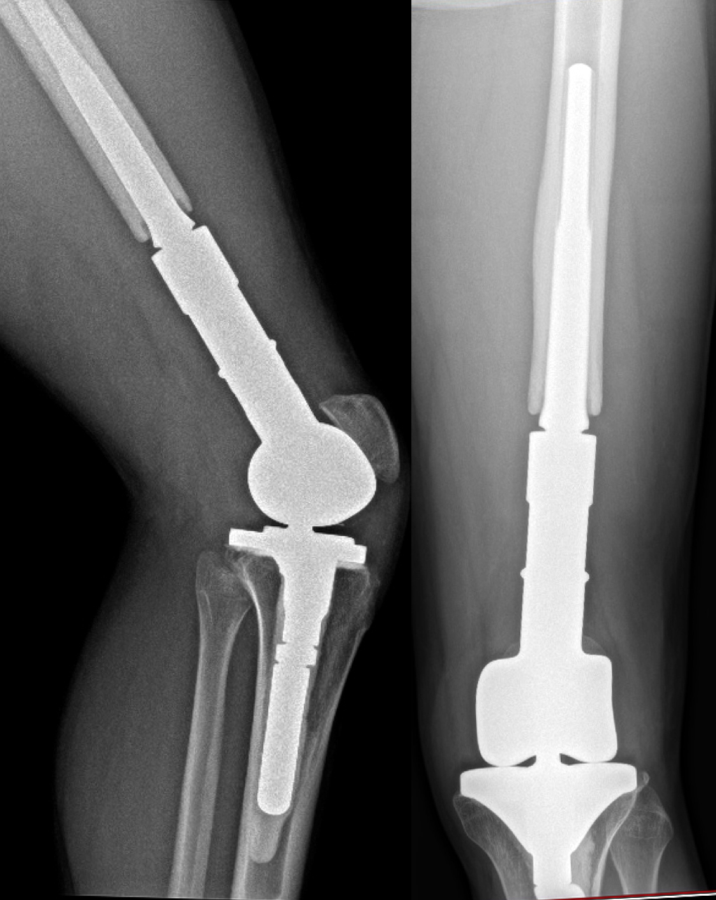 RTG tumorózní náhrady. Zesílení kosti kolem dříku ("stress-shielding") poukazuje na dobrou integraci implantátu, který je mladým člověkem plně zatěžován.