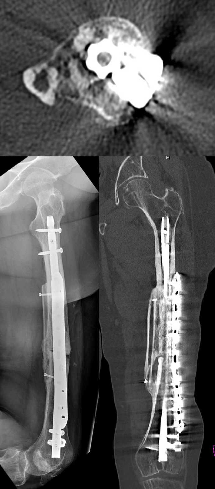 RTG a CT ukazují splynutí fibuly s původní kostí a přehojení zlomeniny