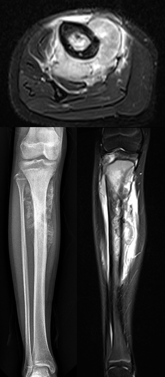 RTG a MRI ukazující rozsah nádorového postižení holenní kosti s velkou extraosseální složkou (šířením mimo kost)