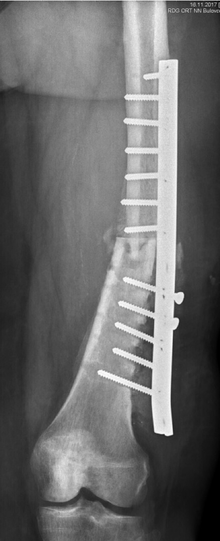 RTG snímek ukazující, v pořadí již třetí, selhanou osteosyntézu ozářené kosti