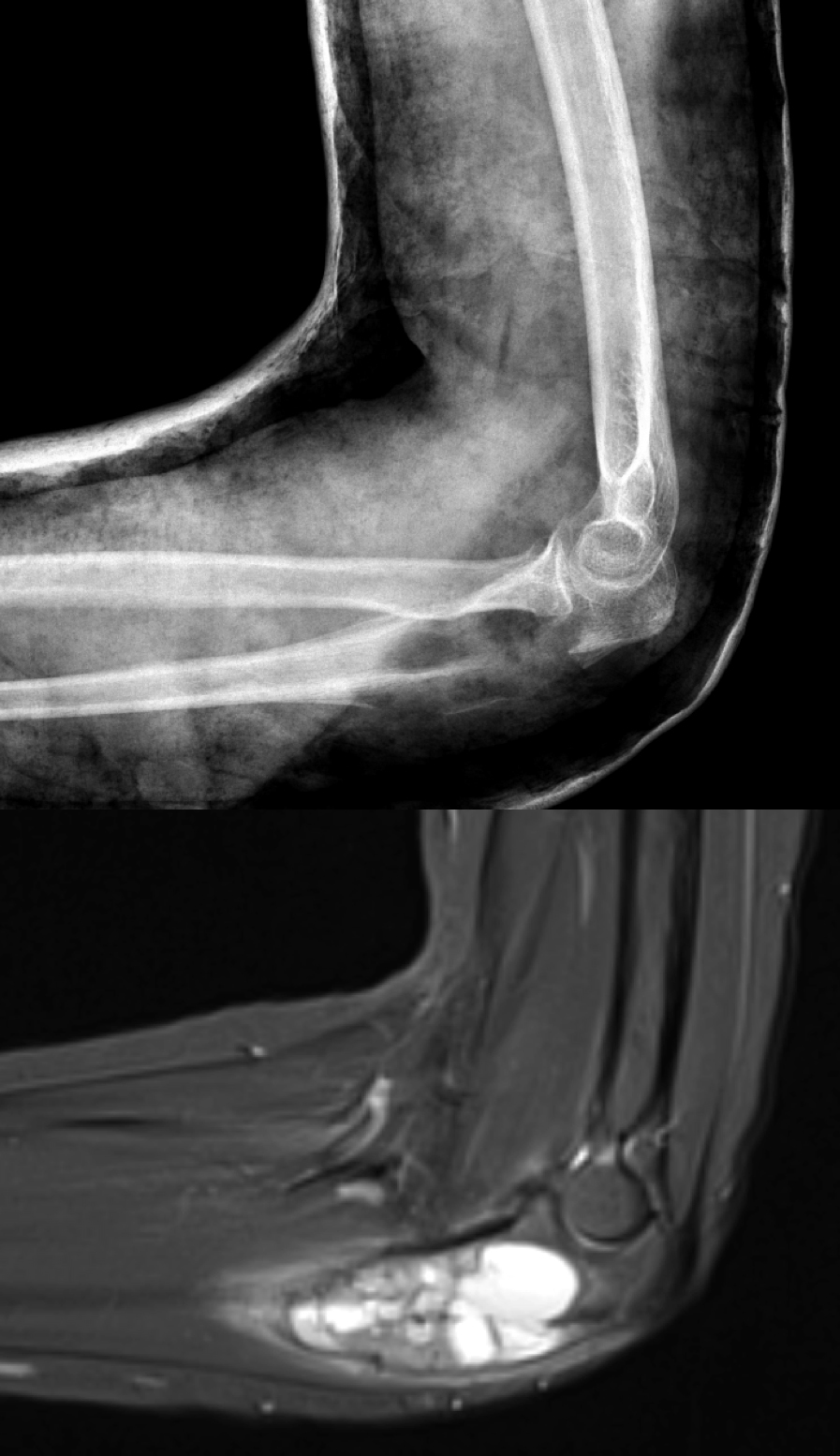 RTG a MRI ukazující tumor loketní kosti (proximální ulny)