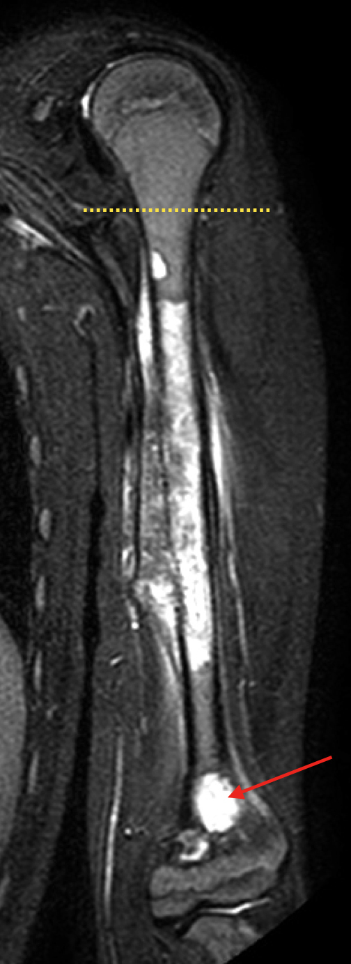 MRI ukazující rozsah infiltrace ramene tumorem, červená šipka značí "skip metastázu", žlutá linii resekce