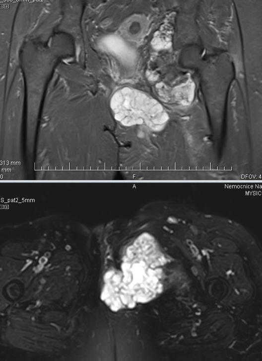MRI nádoru obrůstajícího kyčelní kloub