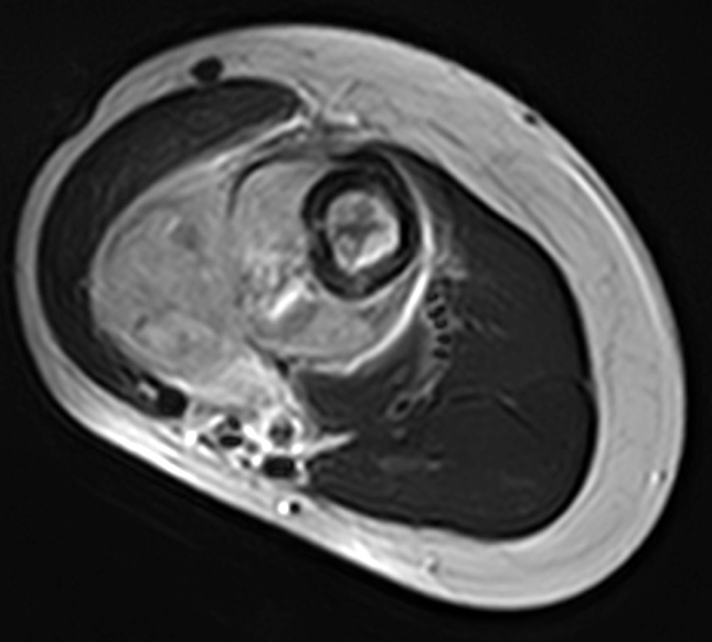 MRI - axiální snímek nádoru