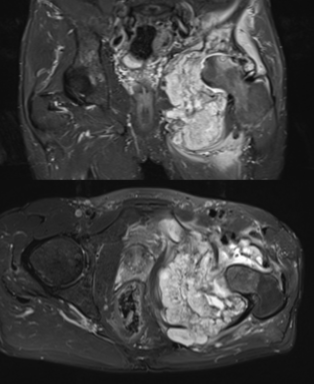 MRI ukazující rozsah tumoru