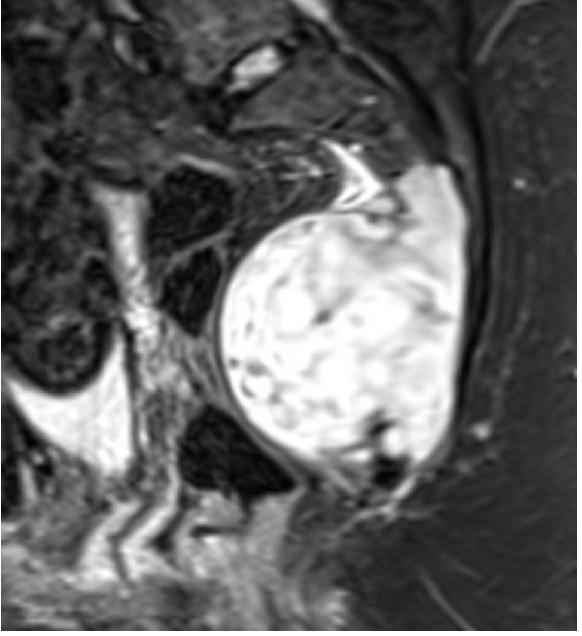 MRI - tumor infiltruje celou křížovou kost s vyjímkou těla S1 a vepředu utlačuje střevo
