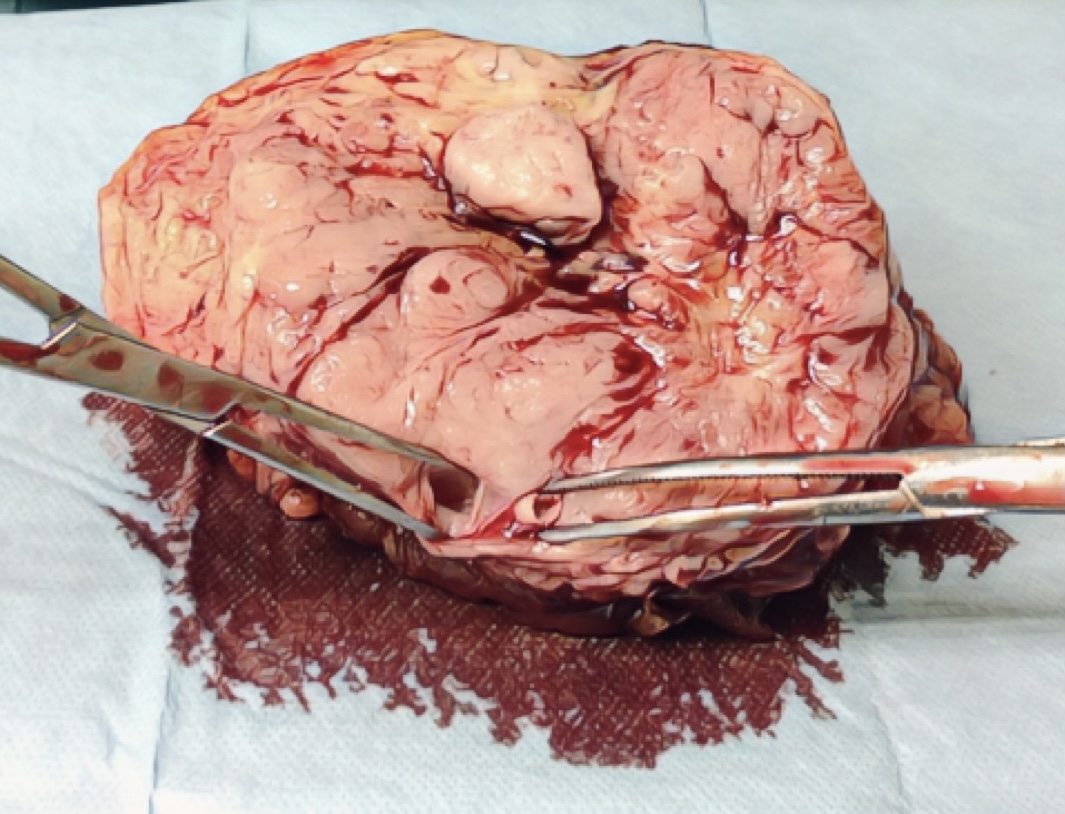 Klinický obrázek rozpolceného tumoru, kde je vidět, že cévy jsou zcela obkouženy tumorem.