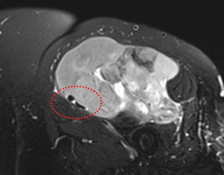 MRI ukazující infiltraci femorálního cévního svazku.