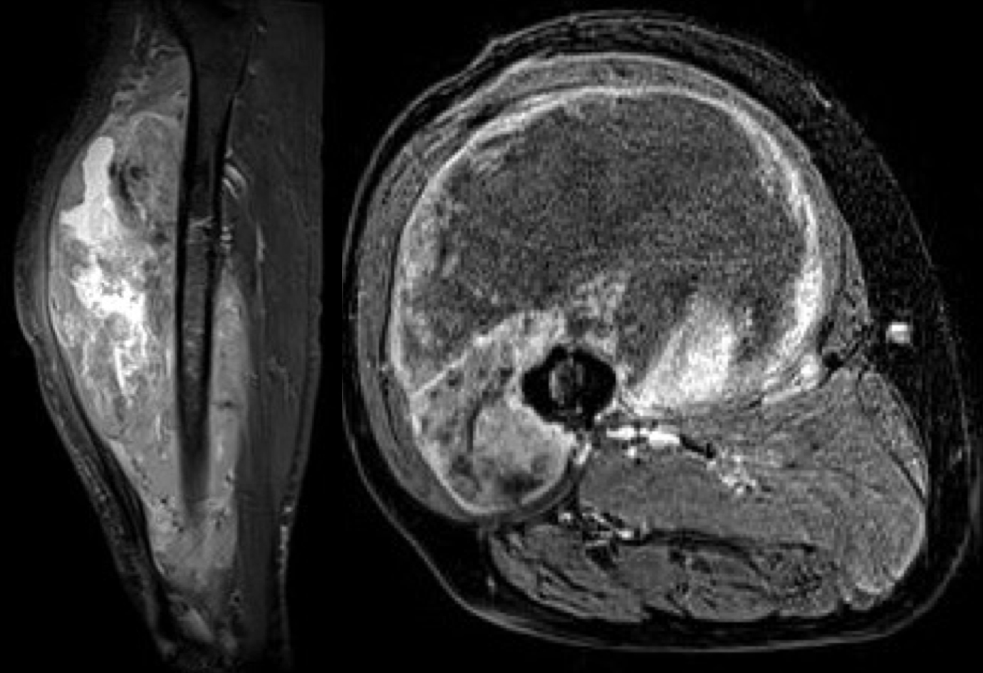 MRI ukazující tumor zasahující celý 4-hlavý sval. Vlevo je vidět edém kostní dřeně a vpravo nerovná kontura zasažené kosti