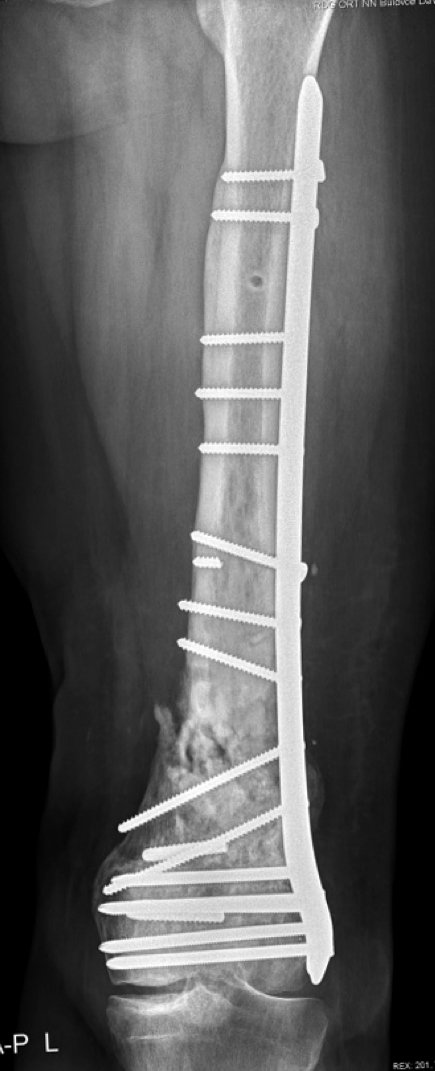 RTG snímek, kde je vidět avitální pakloub a rozpad kosti distálního femuru v terénu fistulující osteomyelitidy