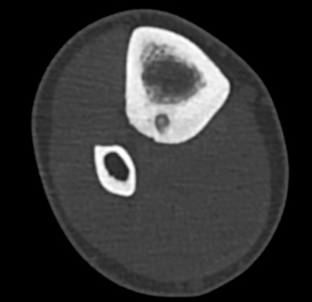 HRCT (high-resolution computed tomography) - kostní rekonstrukce na CT krásně zobrazují “nidus”, který je zodpovědný za bolesti pacienta