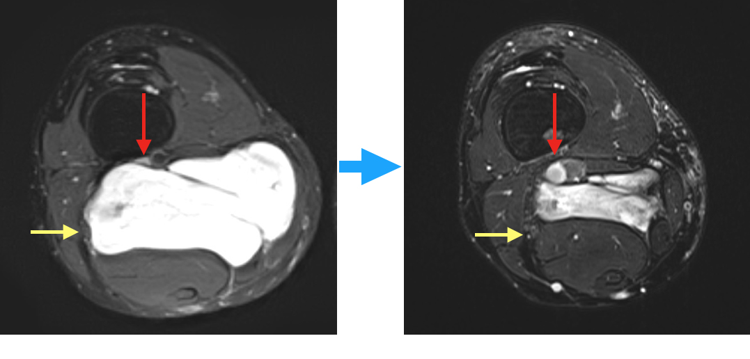 MRI před a po HILP - je vidět zmenšení tumoru a uvolnění cév a sedacího nervu (šipky)