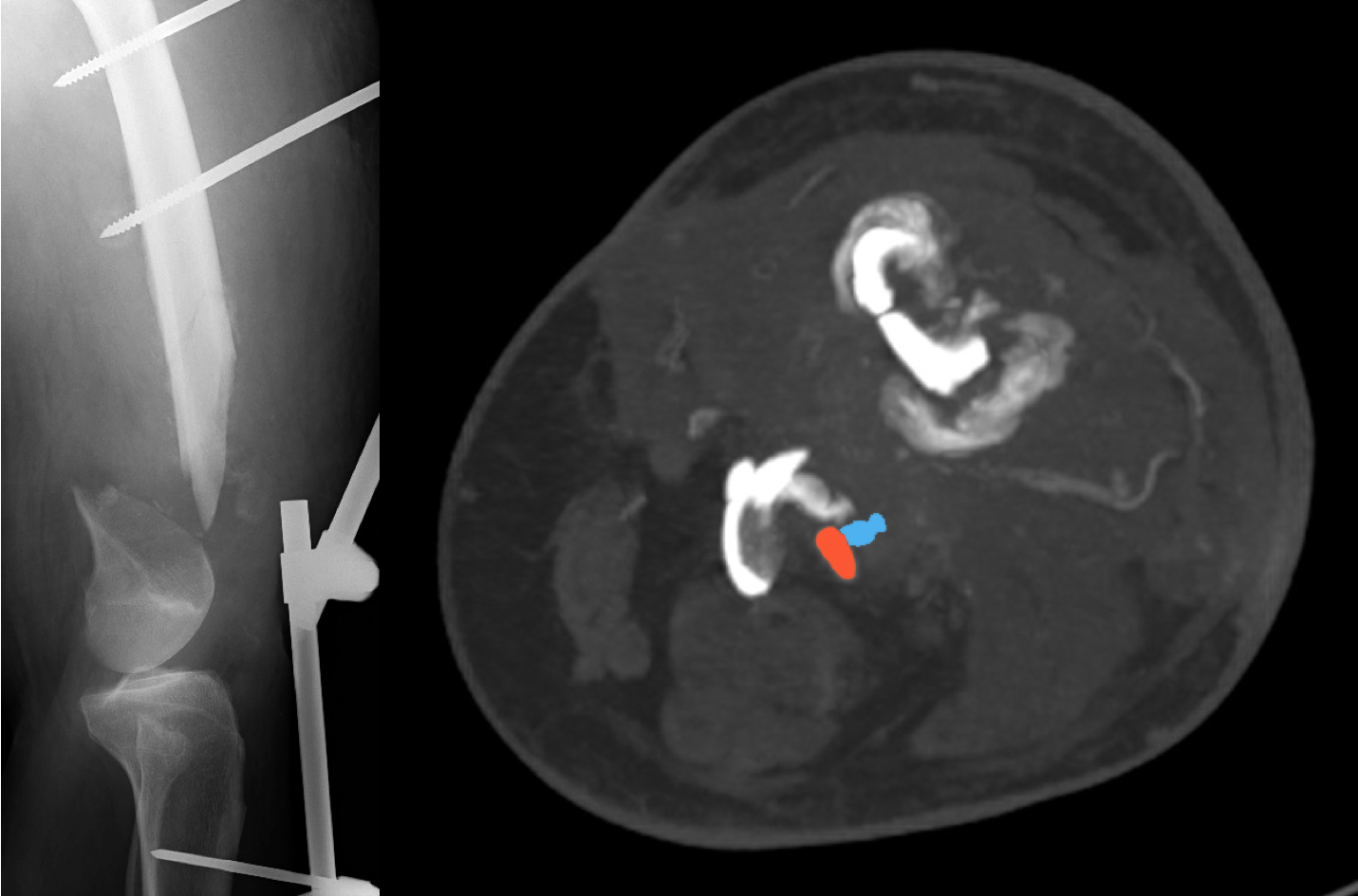 RTG a CT před operací demostrujcí ztrátu 15cm femuru, čéšky a jednoho kondylu stehenní kosti. Modrá a červená značí cévy zavzaté do tvořícího-se kostěného svalku.