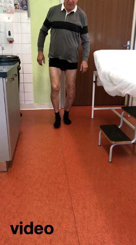 video chůze pacienta 6 let od operace
