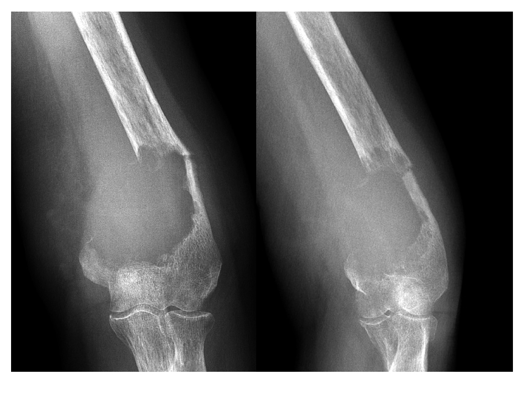 RTG zobrazující rozsáhlou nádorovou destrukci pažní kosti s patologickou zlomeninou