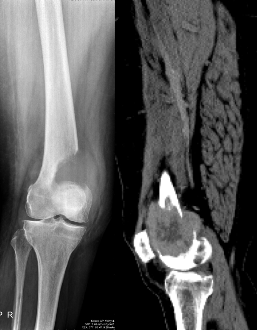 RTG a CT ukazující nádorovou destrukci stehenní kosti těsně nad kolenem