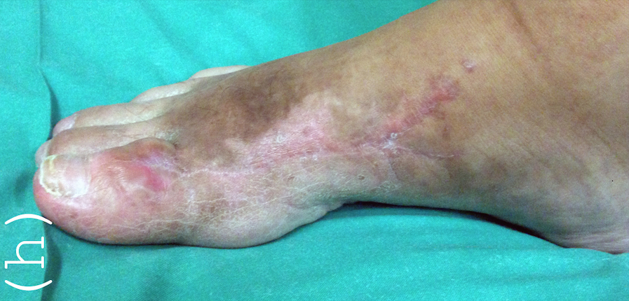Klinické foto nohy na ambulantní kontrole - pacient chodí bez opory v normální obuvy