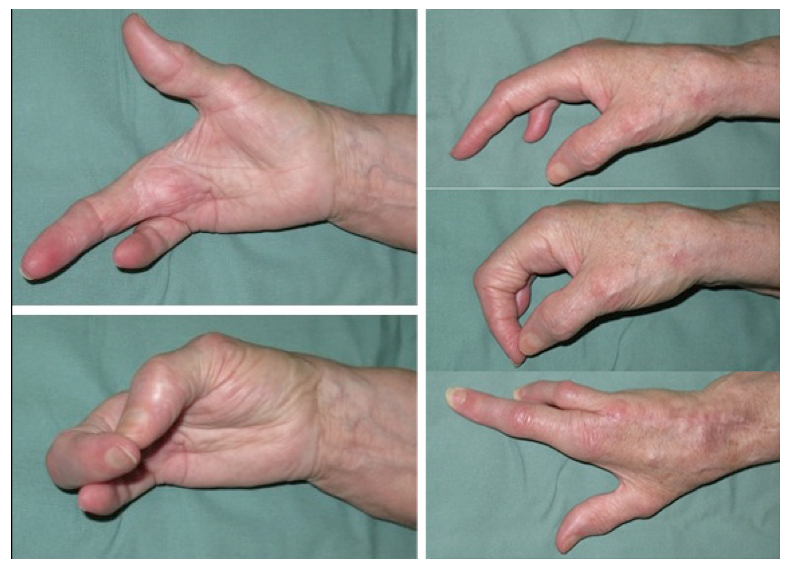 klinické foto funkce ruky po operace