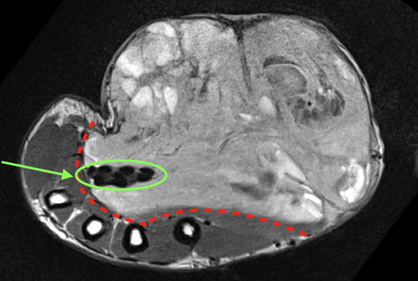 MRI rozsahu tumoru (cervena linie). Zelená barva značí obkroužený karalní tunel