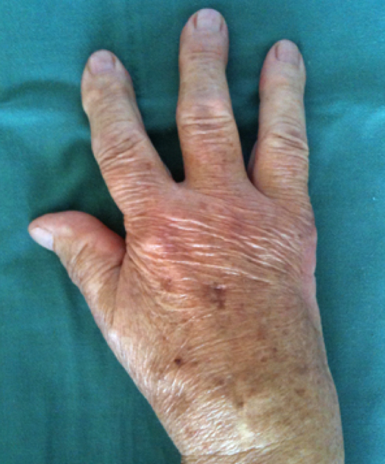 klinické foto ruky 3r od operace