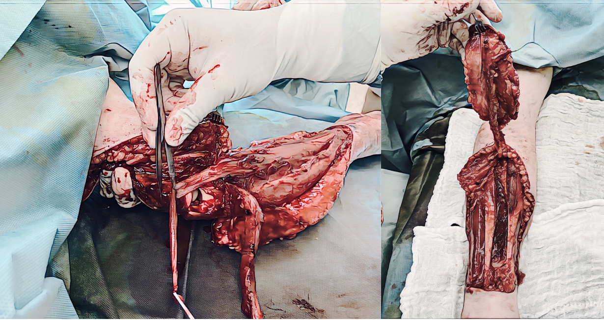 Peroperační foto rekonstrukce lokte a odběru arteriálního laloku